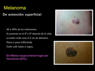 MelanomaMelanoma
De extensión superficialDe extensión superficial
40 a 50% de los melanomas.
Se presenta en el 4º y 5º decenio de la vida.
La lesión mide unos 2.5 cm de diámetro
Plana o poco infiltratada
Color café rojizo o negro.
En México ocupa el tercer lugar por
frecuencia (20%).
 