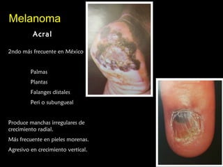 MelanomaMelanoma
AcralAcral
2ndo más frecuente en México
Palmas
Plantas
Falanges dístales
Peri o subungueal
Produce manchas irregulares de
crecimiento radial.
Más frecuente en pieles morenas.
Agresivo en crecimiento vertical.
 