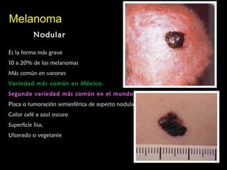 MelanomaMelanoma
NodularNodular
Es la forma más grave
10 a 20% de los melanomas
Más común en varones
Variedad más común en México.
Segunda variedad más común en el mundo.
Placa o tumoración semiesférica de aspecto nodular.
Color café a azul oscuro
Superficie lisa,
Ulcerado o vegetante
 