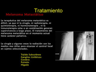 TratamientoTratamiento
Melanoma MetastáticoMelanoma Metastático
La terapéutica del melanoma metastático es
difícil, ya que ni la cirugía, ni radioterapia, ni
quimioterapia, ni hormonoterapia , ni la
inmunoterapia solas o en combinación generan
supervivencia a largo plazo. El tratamiento del
melanoma metastático en el momento actual
tiene carácter paliativo.
La cirugía y algunas veces la radiación son los
medios mas útiles para alcanzar el control local
en sujetos seleccionados.
Tejido Subcutáneo
Ganglios Linfáticos
Cerebro
Pulmón
Hígado
 