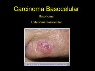 Carcinoma BasocelularCarcinoma Basocelular
BasoliomaBasolioma
Epitelioma BasocelularEpitelioma Basocelular
 