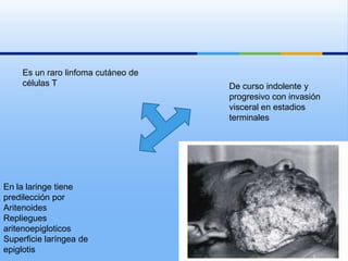 Es un raro linfoma cutáneo de
    células T                       De curso indolente y
                                    progresivo con invasión
                                    visceral en estadios
                                    terminales




En la laringe tiene
predilección por
Aritenoides
Repliegues
aritenoepigloticos
Superficie laríngea de
epiglotis
 