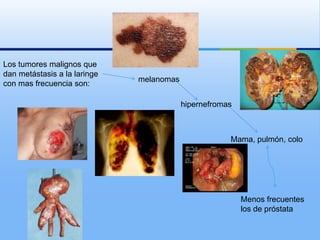 Los tumores malignos que
dan metástasis a la laringe
                              melanomas
con mas frecuencia son:

                                          hipernefromas



                                                      Mama, pulmón, colo
                                                      n




                                                          Menos frecuentes
                                                          los de próstata
 