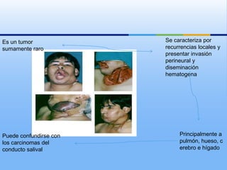 Es un tumor             Se caracteriza por
sumamente raro          recurrencias locales y
                        presentar invasión
                        perineural y
                        diseminación
                        hematogena




Puede confundirse con        Principalmente a
los carcinomas del           pulmón, hueso, c
conducto salival             erebro e hígado
 
