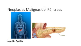 Neoplasias Malignas del Páncreas
Janseilin Castillo
 