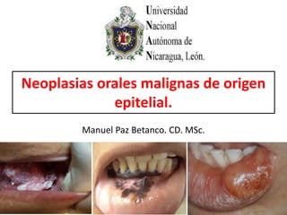 Neoplasias orales malignas de origen
epitelial.
Manuel Paz Betanco. CD. MSc.
 