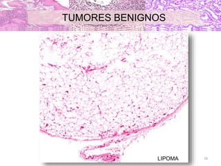 LIPOMA
TUMORES BENIGNOS
16
 