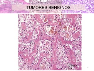 OSTEO
MA
TUMORES BENIGNOS
18
 