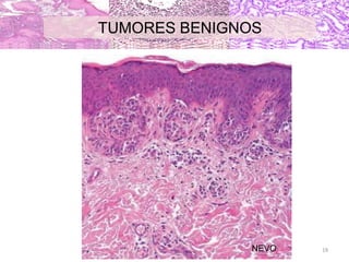 NEVO
TUMORES BENIGNOS
19
 