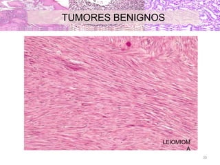 LEIOMIOM
A
TUMORES BENIGNOS
20
 