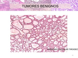 ADENOMA FOLICULAR TIROIDEO
TUMORES BENIGNOS
21
 