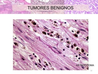 ASTROCITOMA
TUMORES BENIGNOS
22
 