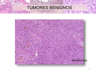 MENINGIOMA
TUMORES BENIGNOS
23
 