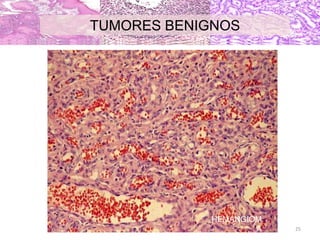 HEMANGIOM
A
TUMORES BENIGNOS
25
 
