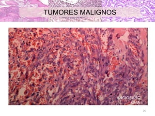 TUMORES MALIGNOS
ANGIOSARC
OMA
26
 