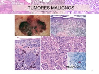 MELANOMA
TUMORES MALIGNOS
27
 