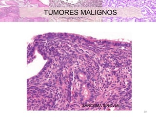 SARCOMA SINOVIAL
TUMORES MALIGNOS
28
 