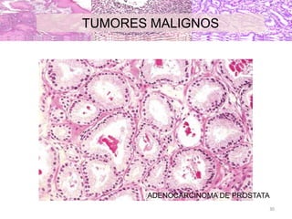 ADENOCARCINOMA DE PROSTATA
TUMORES MALIGNOS
30
 