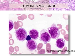 TUMORES MALIGNOS
LEUCEMIA LINFOBLÁSTICA AGUD
31
 