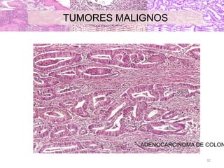 TUMORES MALIGNOS
ADENOCARCINOMA DE COLON
32
 