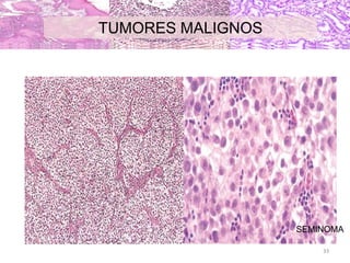TUMORES MALIGNOS
SEMINOMA
33
 