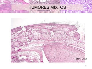 TUMORES MIXTOS
TERATOMA
36
 