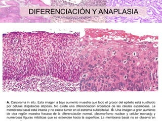 42
A. Carcinoma in situ. Esta imagen a bajo aumento muestra que todo el grosor del epitelio está sustituido
por células displásicas atípicas. No existe una diferenciación ordenada de las células escamosas. La
membrana basal está intacta y no existe tumor en el estroma subepitelial. B. Una imagen a gran aumento
de otra región muestra fracaso de la diferenciación normal, pleomorfismo nuclear y celular marcado y
numerosas figuras mitóticas que se extienden hacia la superficie. La membrana basal no se observa en
DIFERENCIACIÓN Y ANAPLASIA
 