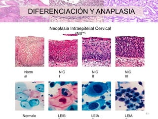 43
Neoplasia Intraepitelial Cervical
(NIC)
Norm
al
NIC
I
NIC
II
NIC
III
Normale LEIB LEIA LEIA
DIFERENCIACIÓN Y ANAPLASIA
 