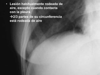 • Lesión habitualmente rodeada de
aire, excepto cuando contacta
con la pleura
2/3 partes de su circunferencia
está rodeada de aire

 