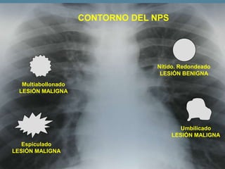CONTORNO DEL NPS

Nítido. Redondeado
LESIÓN BENIGNA
Multiabollonado
LESIÓN MALIGNA

Umbilicado
LESIÓN MALIGNA
Espiculado
LESIÓN MALIGNA

 