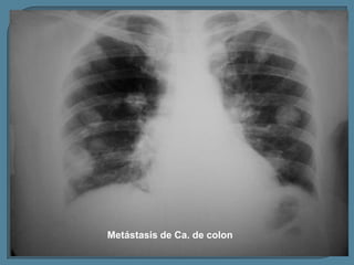 Metástasis de Ca. de colon

 