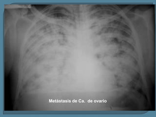 Metástasis de Ca. de ovario

 