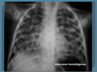 Abscesos hematógenos

 
