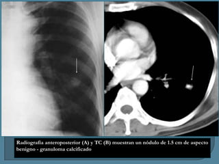 Radiografía anteroposterior (A) y TC (B) muestran un nódulo de 1.5 cm de aspecto
benigno - granuloma calcificado

 