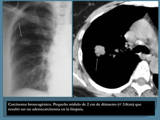 Carcinoma broncogénico. Pequeño nódulo de 2 cm de diámetro (< 3.0cm) que
resultó ser un adenocarcinoma en la biopsia.

 
