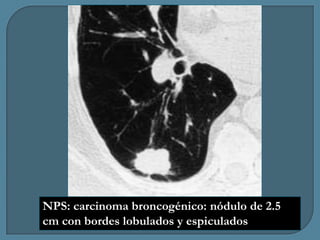 NPS: carcinoma broncogénico: nódulo de 2.5
cm con bordes lobulados y espiculados

 