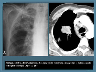 A

B

Márgenes lobulados: Carcinoma broncogénico mostrando márgenes lobulados en la
radiografía simple (A) y TC (B)

 