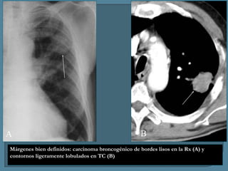 A

B

Márgenes bien definidos: carcinoma broncogénico de bordes lisos en la Rx (A) y
contornos ligeramente lobulados en TC (B)

 
