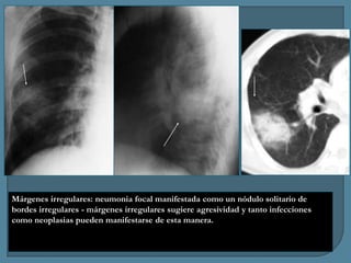 Márgenes irregulares: neumonia focal manifestada como un nódulo solitario de
bordes irregulares - márgenes irregulares sugiere agresividad y tanto infecciones
como neoplasias pueden manifestarse de esta manera.

 