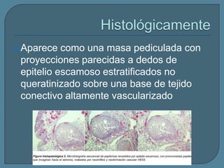  Aparece

como una masa pediculada con
proyecciones parecidas a dedos de
epitelio escamoso estratificados no
queratinizado sobre una base de tejido
conectivo altamente vascularizado

 