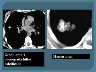 Granuloma +
adenopatía hiliar
calcificada

Hamartoma

 