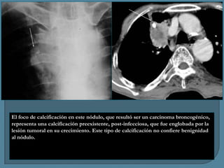 El foco de calcificación en este nódulo, que resultó ser un carcinoma broncogénico,
representa una calcificación preexistente, post-infecciosa, que fue englobada por la
lesión tumoral en su crecimiento. Este tipo de calcificación no confiere benignidad
al nódulo.

 