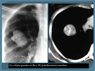 Ca. células grandes en Rx y TC (calcificaciones amorfas)

 
