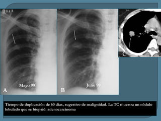 C

A

Mayo 99

B

Julio 99

Tiempo de duplicación de 60 días, sugestivo de malignidad. La TC muestra un nódulo
lobulado que se biopsió: adenocarcinoma

 