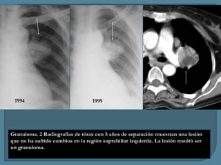 1994

1999

Granuloma. 2 Radiografías de tórax con 5 años de separación muestran una lesión
que no ha sufrido cambios en la región suprahiliar izquierda. La lesión resultó ser
un granuloma.

 