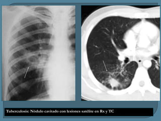Tuberculosis: Nódulo cavitado con lesiones satélite en Rx y TC

 