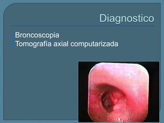  Broncoscopia

 Tomografía

axial computarizada

 