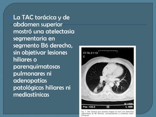  La

TAC torácica y de
abdomen superior
mostró una atelectasia
segmentaria en
segmento B6 derecho,
sin objetivar lesiones
hiliares o
parenquimatosas
pulmonares ni
adenopatías
patológicas hiliares ni
mediastínicas

 