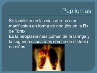  Se

localizan en las vias aereas o se
manifiestan en forma de nodulos en la Rx
de Torax
 Es la neoplasia mas comun de la laringe y
la segunda causa mas comun de disfonia
en niños

 