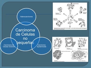 Adenocarcinoma

Carcinoma de
Celulas Grandre

Carcinoma
de Celulas
no
pequeñas

Carcinoma
Epidermoide

 